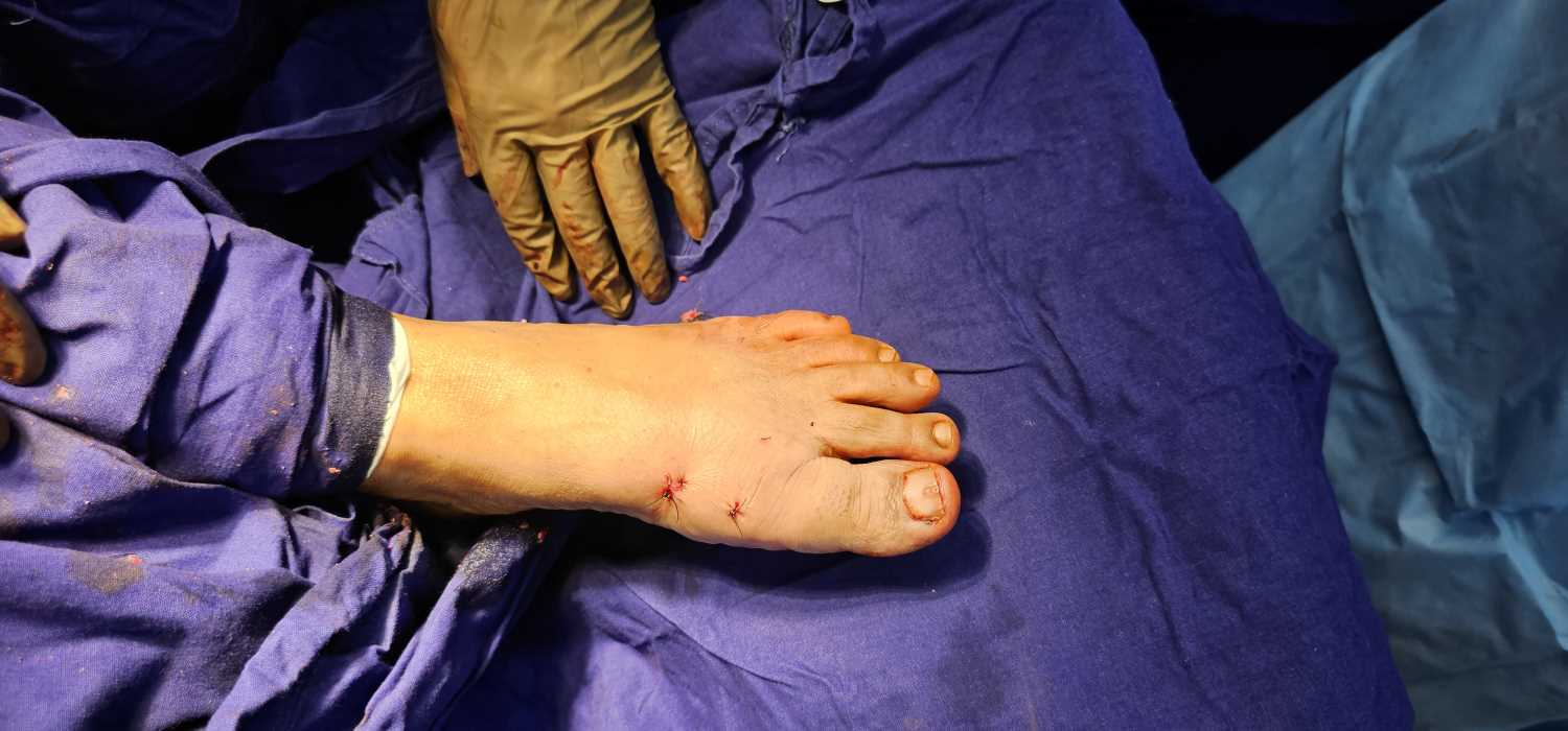Minimally Invasive Surgery for Foot | MKFAC