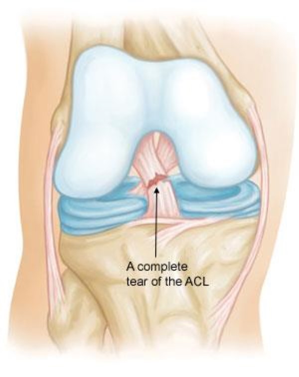 Best Doctor for ACL Surgery in Mumbai | Dr Pradeep Moonot
