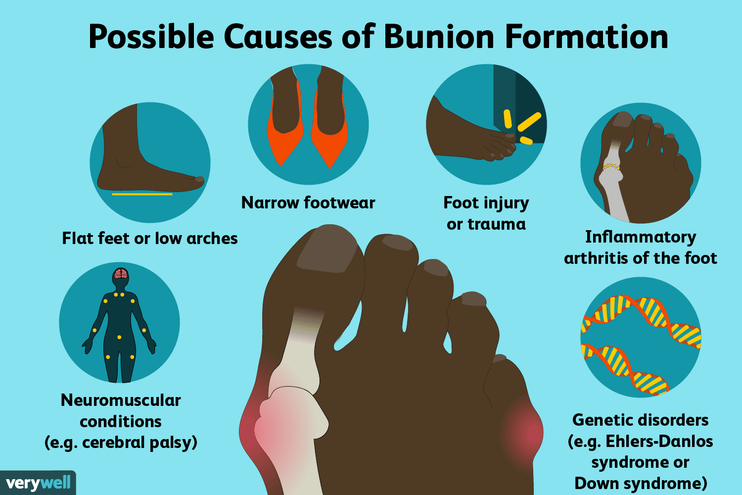 Possible Causes of Bunion Formation | MKFAC