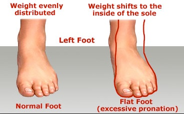 Flat Foot Surgical Treatment in Mumbai | MKFAC