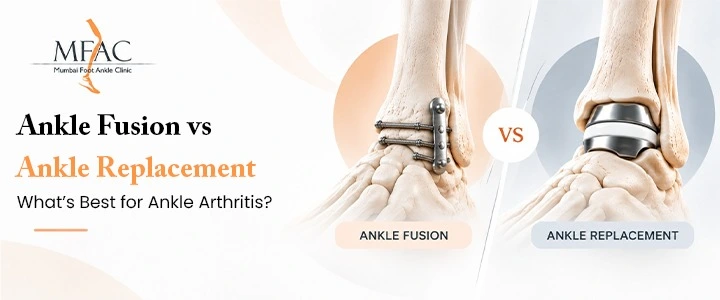 Ankle fusion vs ankle replacement for ankle arthritis