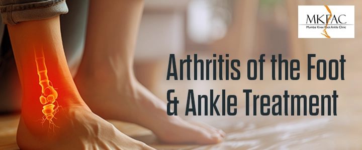 Arthritis of the Foot and Ankle Treatment