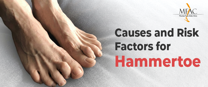 Recognize Hammertoes and Corns | MFAC