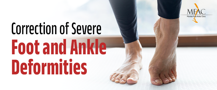 Correction of Severe Foot and Ankle Deformities | MFAC