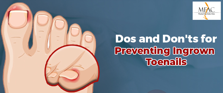 Dos and Don'ts for Preventing Ingrown Toenails