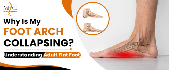 Adult flat foot treatment in Mumbai showing a collapsed foot arch and foot pain