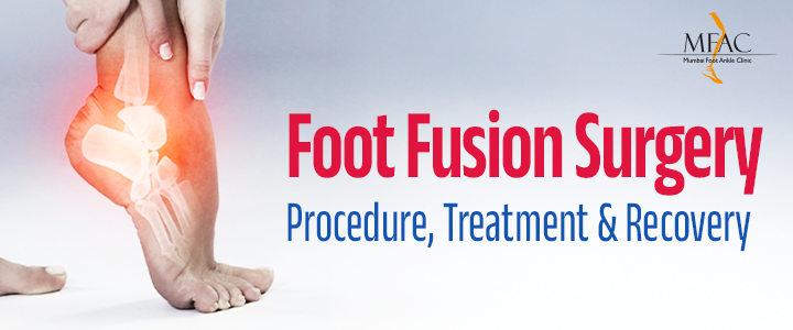Foot Fusion Surgery Procedure, Treatment, and Recovery | MFAC | Dr. Pradeep Moonot