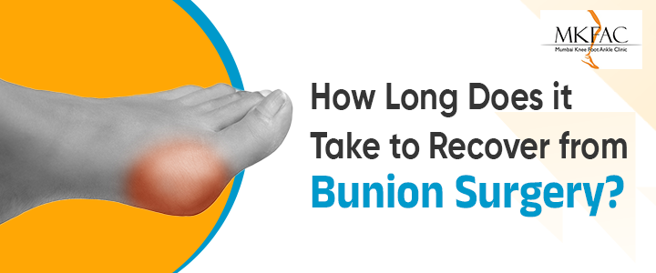 How Long Does it Take to Recover from Bunion Surgery | MKFAC