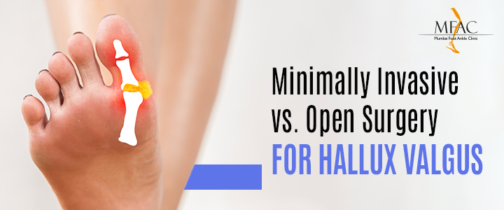 Minimally Invasive vs. Open Surgery for Hallux Valgus