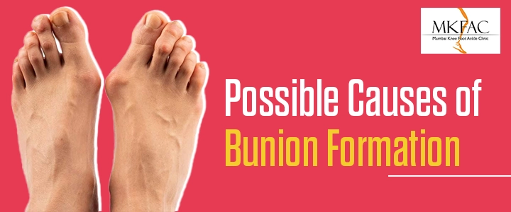 Possible Causes of Bunion Formation