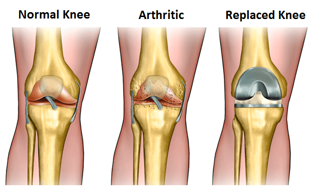 Best Knee Replacement Surgeon in Mumbai | Dr Pradeep Moonot